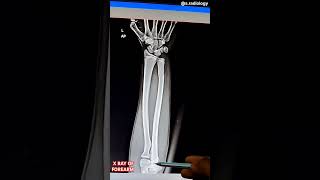 FRACTURE OF ULNA BONE [upl. by Krik310]