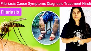 Filariasis Cause Symptoms Diagnosis Treatment in Hindi  Filariasis Cause by  What is Filariasis [upl. by Lia240]