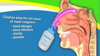 Nasal Irrigation to Treat Sinusitis Common Cold Allergy Better Than Neti Pots [upl. by Roanne]