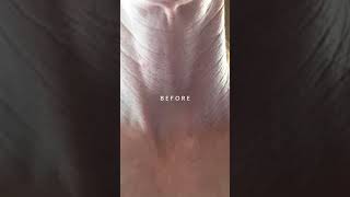 JawDropping RESULTS From Using The FasciaBlaster On My Neck  Before and After Comparison [upl. by Allimaj]