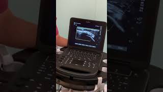 UltrasoundGuided Barbotage for Calcific Tendonitis  Kent MSK Clinic [upl. by Aala]