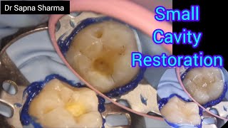 Small Cavity Composite Restoration under Dental Operating Microscope  Simple Class 1 Filling [upl. by Esiahc]