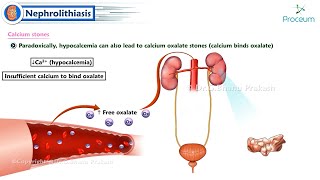 Nephrolithiasis  Kidney stones 🪨   Internal Medicine [upl. by Rinum422]