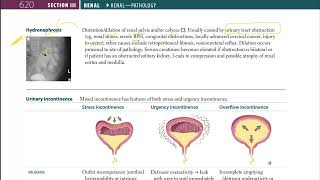 35 Hydronephrosis [upl. by Tesler]