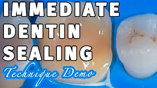 Biomimetic Dentistry Immediate Dentin Sealing with SelfEtch DBA [upl. by Ahsrat83]