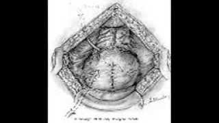 urology lecturs 4suprapubic Prostatectomy [upl. by Durand]