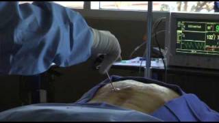 Osteoporosis Pain Watch this Vertebroplasty Procedure  Live [upl. by Oringa]