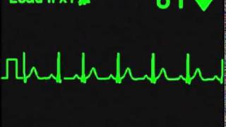 Ritmo Sinusal Normal  Normal Sinus Rhythm [upl. by Edras]