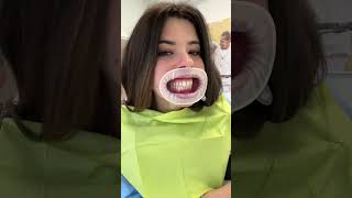 Metto le mascherine trasparenti ai denti shorts vlog dentist [upl. by Faires]