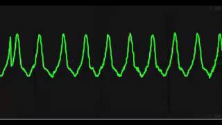 Ventricular Tachycardia VT [upl. by Nodnnarb]