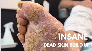 INSANE 😱 DEAD SKIN BUILD UP‼️ Satisfying [upl. by Adin177]