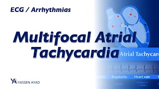 ECG 46  Multifocal Atrial Tachycardia [upl. by Gasparo]