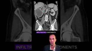 Renal cell carcinoma CT interpretation radiology medicalstudent radiologist radiographer [upl. by Ynos]