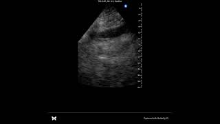 POCUS tamponade case [upl. by Savinirs]