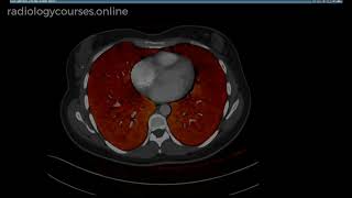 A short lecture DECT Dual Energy CT in CTPA in the evaluation of PE Pulmonary thromboembolism [upl. by Notloc582]