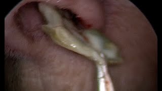 Massive Green Booger Stuck Deep in Nose [upl. by Abocaj]