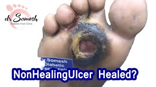 callus ulcertreatment Diabetic Foot case with Before After Video [upl. by Eldin]