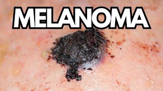 Understanding Melanoma In Seniors Risks Challenges and Importance of Addressing Skin Cancer [upl. by Ettedo87]