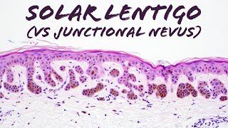 Solar Lentigo vs Junctional Nevus plus sun burn cells amp large cell acanthoma dermpath pathology [upl. by Riay]