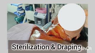 Stellate Ganglion Injection under Fluroscopy by DrVishal Gunjal at Nashik Pain Care Centre [upl. by Tnecnev]