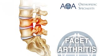 AOA Orthopedic Specialists  Facet Arthritis [upl. by Neirad]