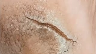 Pedicure video35，A large tear in the heel，vertical plantaris，plantar wart [upl. by Orlina880]