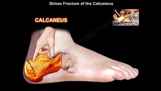 Stress Fracture of the Calcaneus  Everything You Need To Know  Dr Nabil Ebraheim [upl. by Ynor]