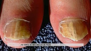 Jai honte de mes ongles de pieds que faire   Le Magazine de la santé [upl. by Tterrej]