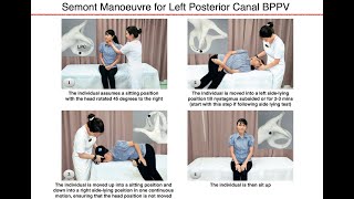 Semont Manoeuvre for Left Posterior Canal BPPV [upl. by Nerdna]