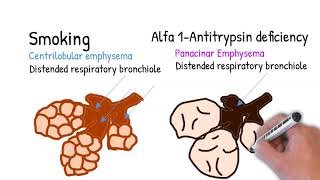 Emphysema  simply explained centrilobular and panacinar emphysema [upl. by Anuahsal76]