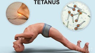 Tetanus Disease tetanusvaccine tetanus tetanusymptoms tetanusdiseaseinurdu [upl. by Sandry]