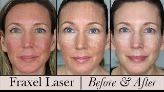 Fraxel Face Laser  Before amp After 3 Month Update [upl. by Lupien]