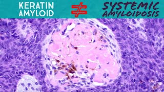 Keratin amyloid NOT systemic amyloidosislight chain AL amyloid dermpath pathology dermatology [upl. by Igiul]