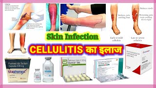 Cellulitis  Cellulitis Treatment  Cellulitis Of The Legs  Cellulitis Skin Infection  Dr Vijay [upl. by Smukler466]