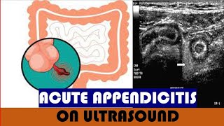 Acute appendicitis on Ultrasound [upl. by Dulcine]