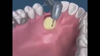 Impacted Canine palatal Surgery [upl. by Odraboel688]