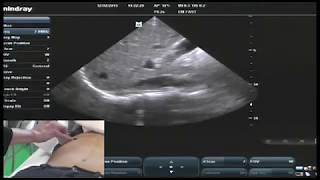 Hot Tips  IVC Volume Assessment with Ultrasound [upl. by Serica663]