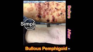 Bullous Pemphigoid Before and After [upl. by Albertson]