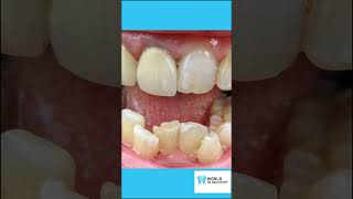 Crooked Teeth 5 Common Causes and How to Avoid them [upl. by Nnahsal575]