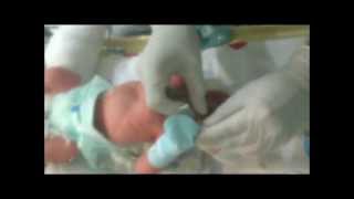 Neonatal Digital Intubation Part 1 [upl. by Heinrick]