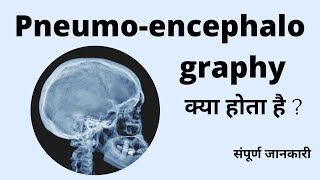 Pneumoencephalography Radiological procedure Air study PEG Study क्या होता है  संपूर्ण जानकारी [upl. by Cindra]