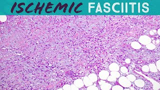 Ischemic fasciitis atypical decubital fibroplasia pseudosarcoma bed sores pathology [upl. by Hewart]