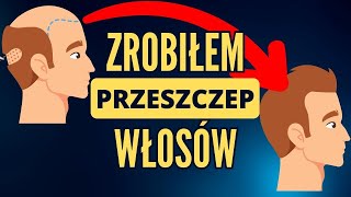 Przeszczep włosów  a po co to komu [upl. by Eart]