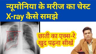 How to Read Chest Pneumonia XRay Findings  फेफड़े का एक्सरे कैसे समझे [upl. by Hum777]