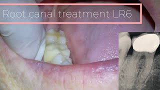 Root Canal Treatment 46 Crown Removal 4K OXO CAMERA [upl. by Uzial665]