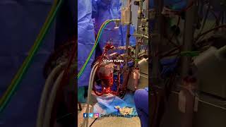 Perfusion aspects by a clinical Perfusionist perfusion nurse [upl. by Mcmahon]