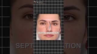 Beautiful Transformation  Piezo Ultrasonic Rhinoplasty I Kyra Aesthetic Clinic youtubeshorts [upl. by Sasha]