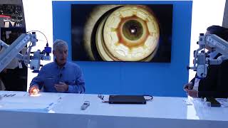 BrightMEM Anterior Keratoplasty ASCRS 2024 [upl. by Niamreg]