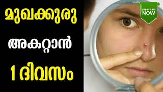 മുഖക്കുരു മാറാൻ 1 ദിവസം Home remedies for pimples in Malayalam [upl. by Ordnasil829]