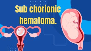 Sub chorionic hematoma Dr Sireesha [upl. by Veedis334]